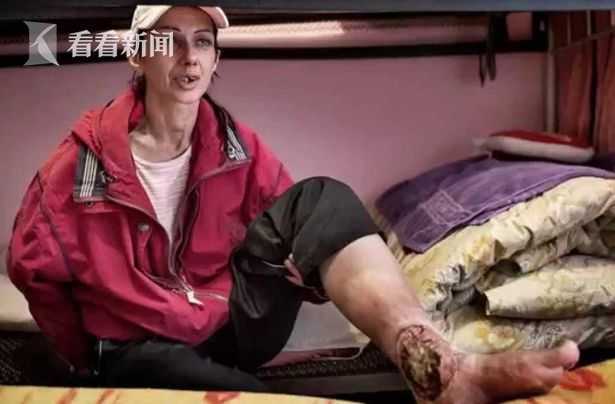 成为英国第一位因注射"世界头号毒品"鳄鱼(krokodil)而全身溃烂的人