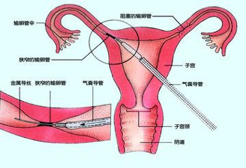 女人对结扎还能不能怀孕,真的了解吗?