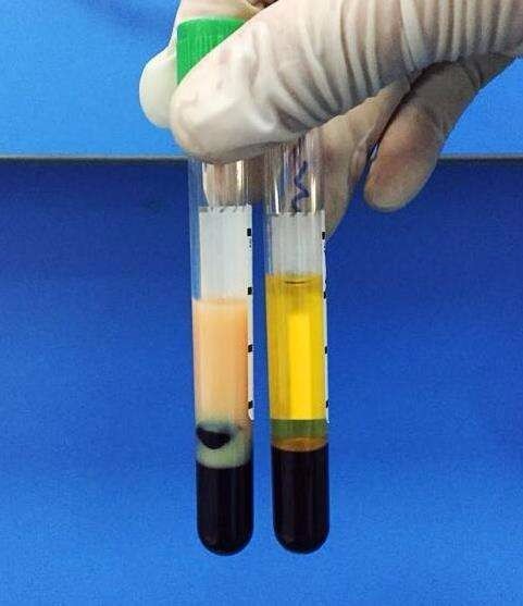 75岁老大爷体内抽出"牛奶血"元凶竟是这种饮食习惯