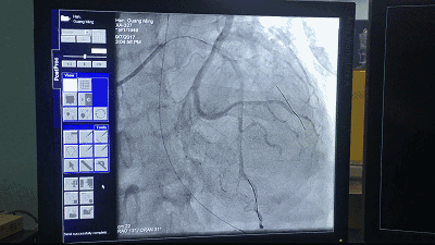 (图为介入手术影像)