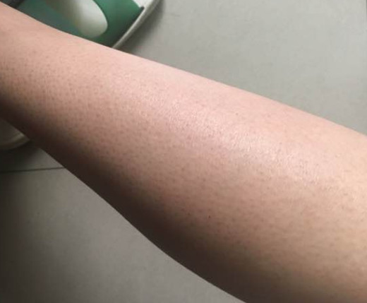毛周角化去角质,这些细节千万注意