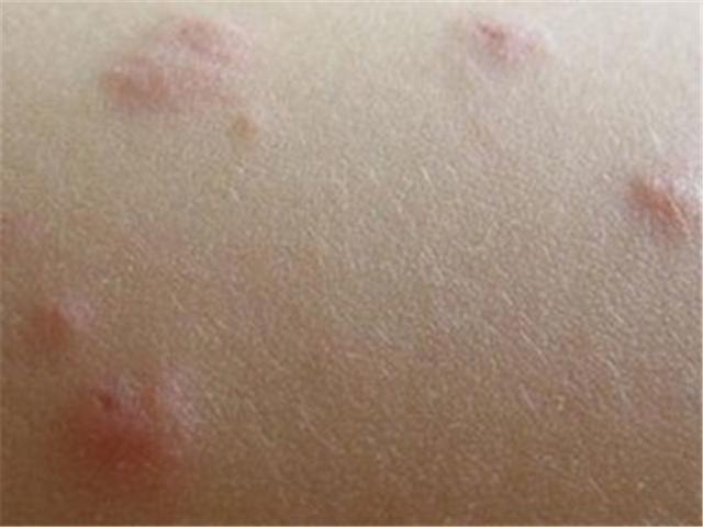 轻度湿疹一般表现为多数密集的粟粒大小的丘疹,丘疱疹或小水疱,基底