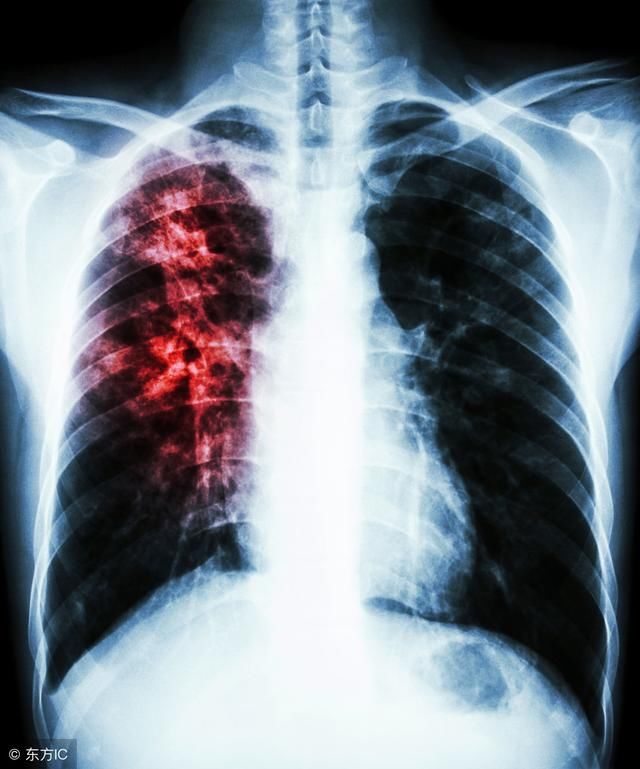 肺结核疾病最容易找上哪六类人群呢