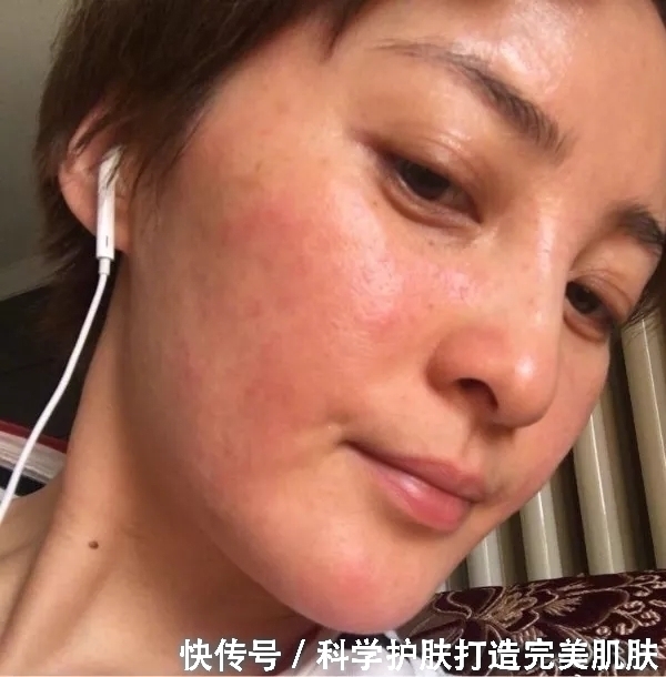 什么是烂脸激素护肤品,明星都不慎踩坑了,你呢?中招了吗?