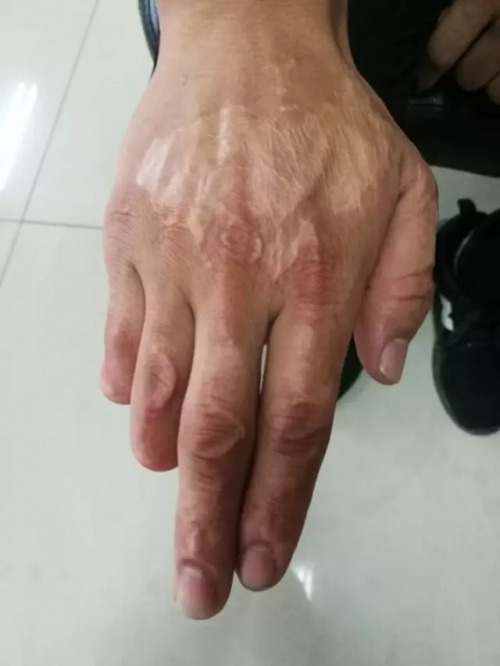 (赵津伟手上的伤疤)