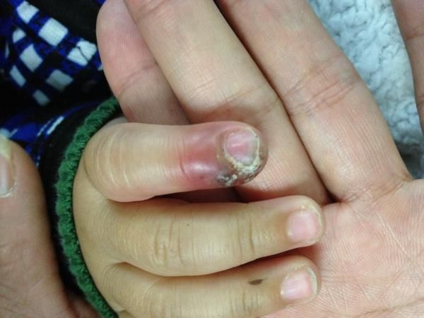 孩子总爱撕咬指甲,甲沟炎?肚子痛?烂牙齿?这些后果你知道吗?