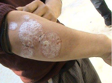 远离神经性皮炎,这些事情你务必做到!