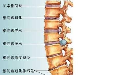 其中以下两种原因较为常见 1,急性腰椎间盘突出