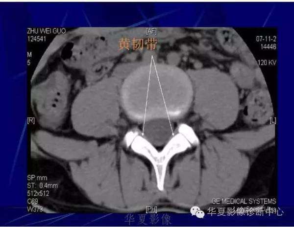详细的腰椎解剖,椎间盘突出,膨出,看这里!