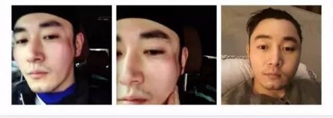意外造成颧骨骨折,脸都被撞到凹了进去,照片真是看一眼都觉得疼呀