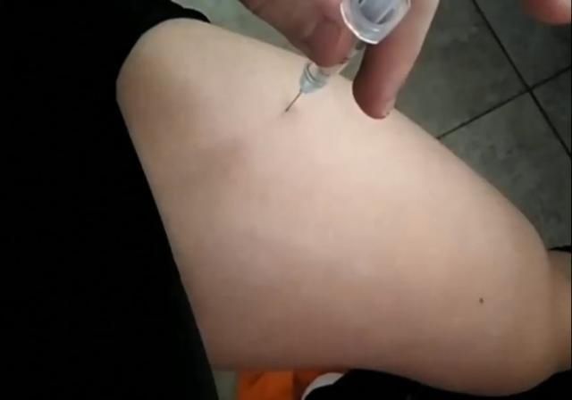 15岁少年健美梦,为长肌肉注射类固醇,长不了个子却一身痤疮!