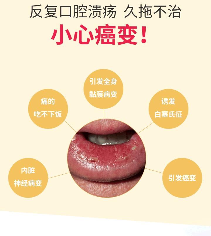 接诊 医生仔细检查后怀疑刘婆婆左侧舌根处的溃疡可能癌变,便将溃疡