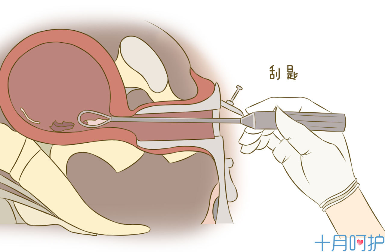 揭露堕胎手术全过程看完这,你还忍心吗?