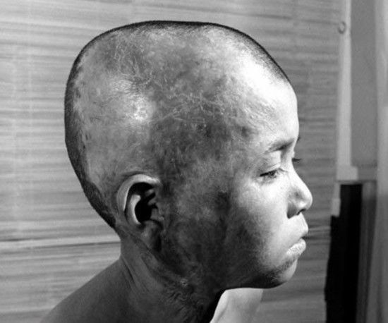 受到辐射的孩子全身的皮肤像是被烧过一般.