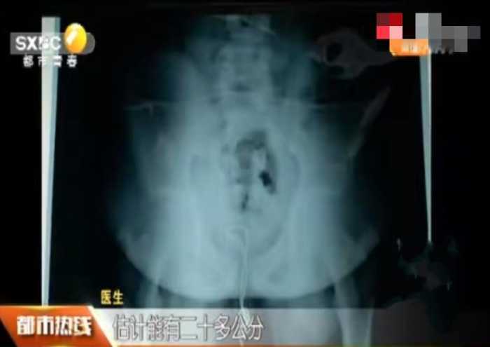 13岁男孩把数据线插入尿道, 塞了20多厘米, 医生: 还打了个死结