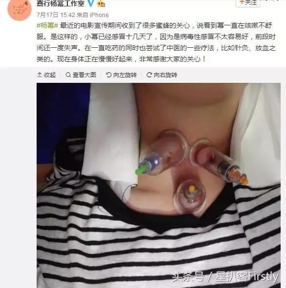 不过拔火罐并不是一件容易的事情,如果操作不当很可能会受伤 歌手齐秦