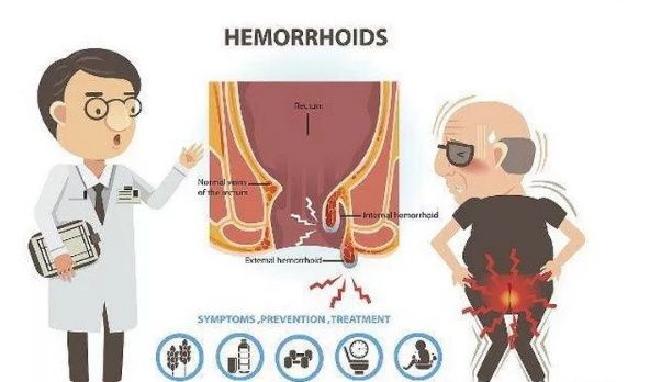 脱出,是痔疮的典型症状,特别是内痔,开始能自行回复,之后,痔疮掉出来