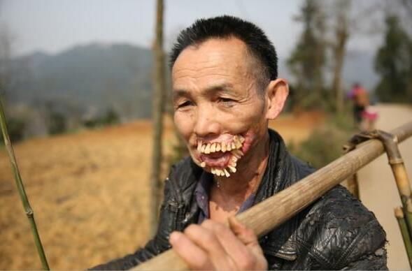 贵州一男子的满口"獠牙",村民害怕皆不敢跟他讲话