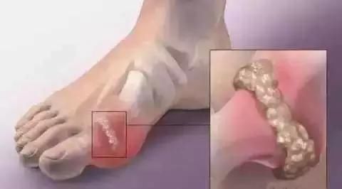 痛风石可在全身的关节附近的骨骼中侵入骨质,形成骨骼畸形,或使骨质