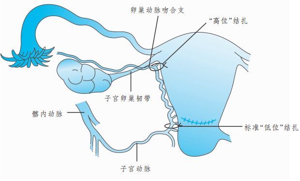 注意事项: 子宫动脉上行支结扎为动,静脉整体结扎,采用可吸收缝线