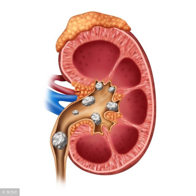 导致肾结石的5个成因,这样预防就对了