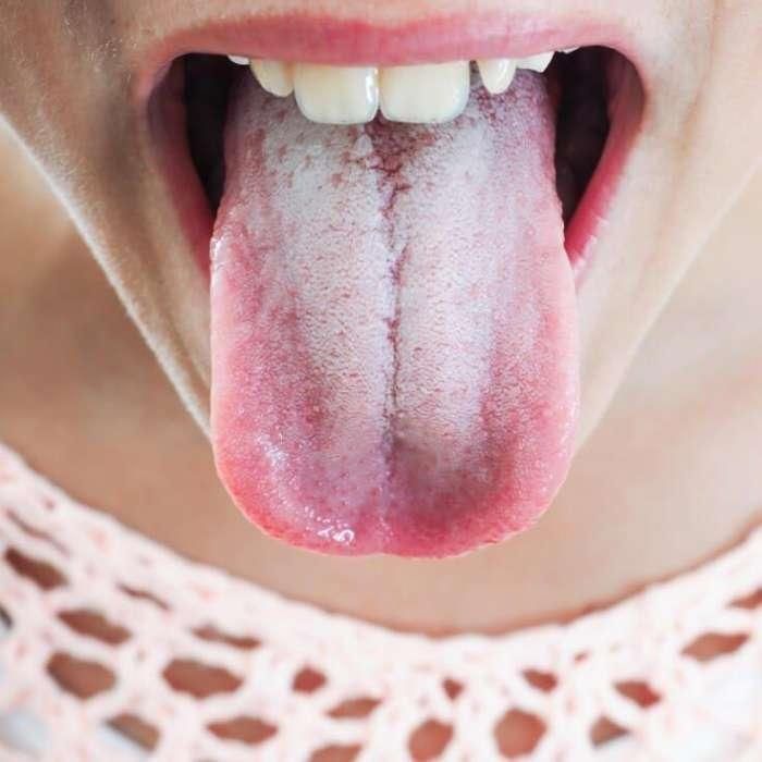 生活中很多人会遇到舌苔发白的现象,造成这一症状的原因有很多,可能