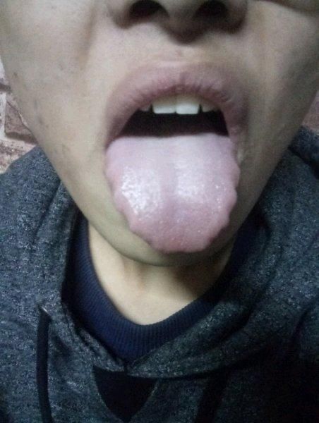 珍贵舌诊:气血亏虚,肝阳亢盛,脾肾阳虚的舌苔,看完记得存!