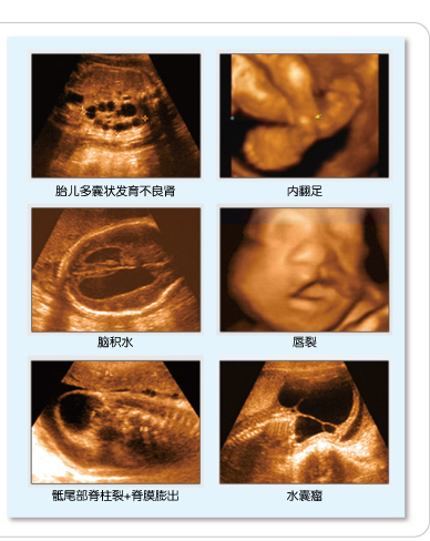因此,四维彩超是不能替代唐氏筛查的,也就是说,四维彩超不能排除唐氏