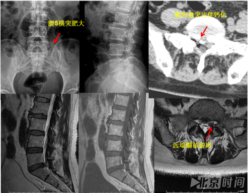 术前mri等检查显示腰横突肥大,椎间孔镜穿刺困难;腰5骶1椎间盘突出