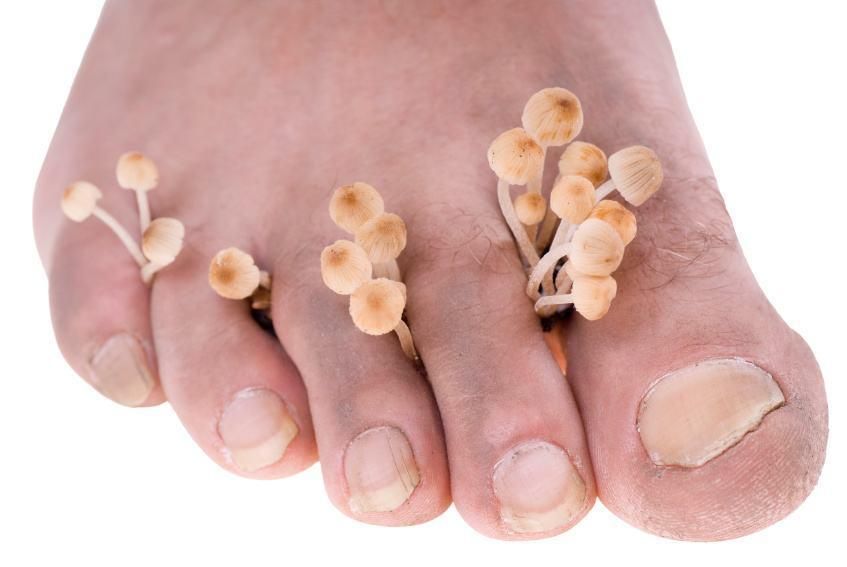 脚气病是缺乏维生素b1引起的一种营养性疾病,它和霉菌感染无关,也不