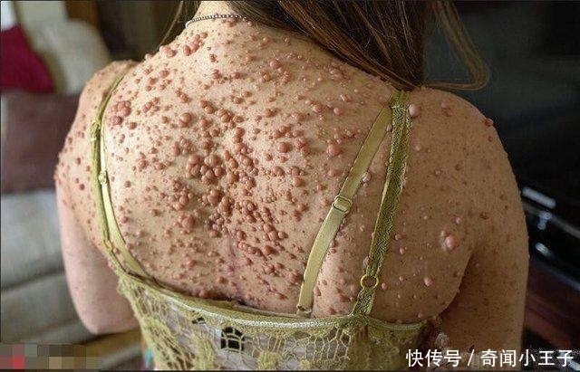 国外女子全身长满近6000肿瘤,皮肤凹凸不平,常年遭受异样眼光!