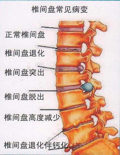 腰间盘突出示意图