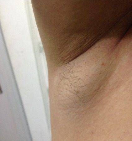 腋下发现有肿块,是淋巴结肿大还是乳腺增生?3招可判别