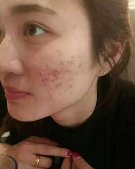 离痘痘,粉刺远点,离美丽更近一点!