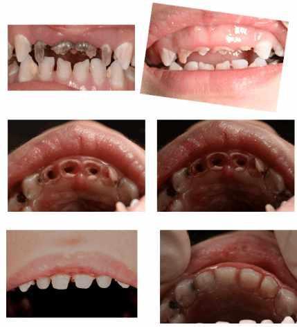 儿童龋齿 上图,全景片显示,乳牙牙本质多颗缺损严重.