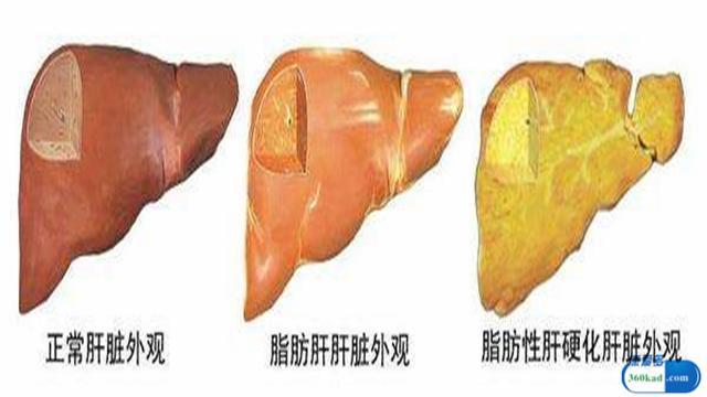 人到中年学会这几点,可远离酒精肝,脂肪肝!