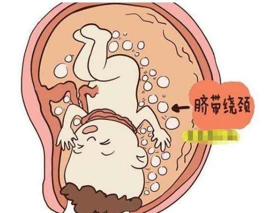 如果你怀孕了,宝宝脐带绕颈一周怎么矫正呢,真实经验分享