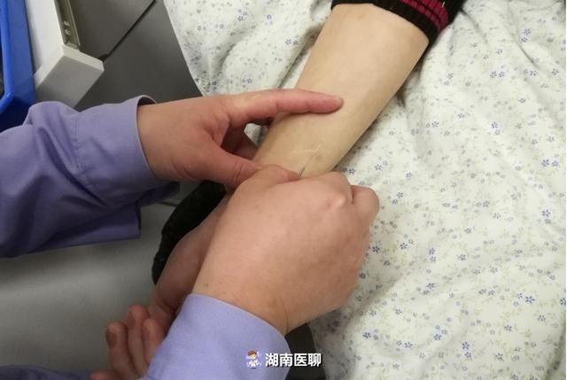 男子打嗝十余年,甚至24小时不停!"手腕扎针"改善症状