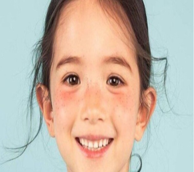 雀斑大概多大年龄治疗效果最好?