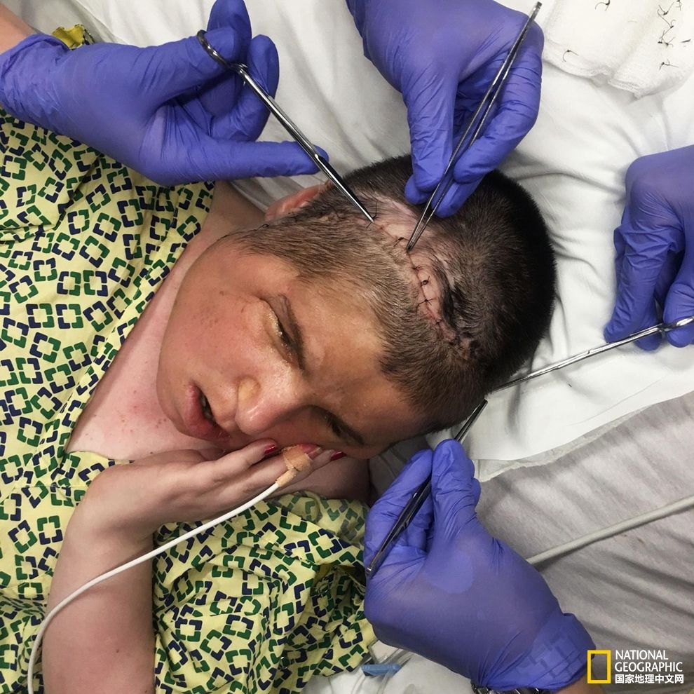 一个毁容女孩的"换脸"全过程