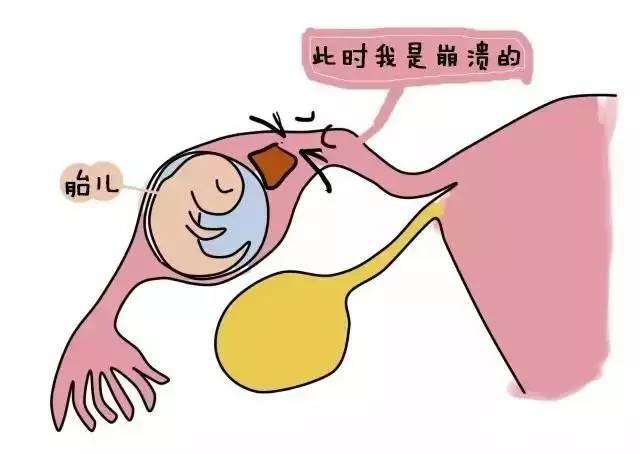 这五种女性最容易患宫外孕?你中招了吗?