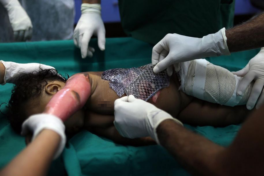 鱼皮覆盖伤口治疗烧伤效果惊人 愈合后鱼皮变成这样