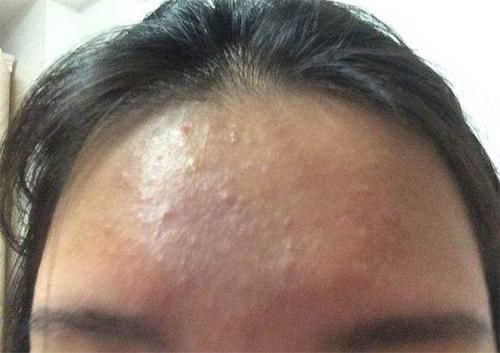 脸上有白头粉刺,还能挤出白色线状物,3方法帮