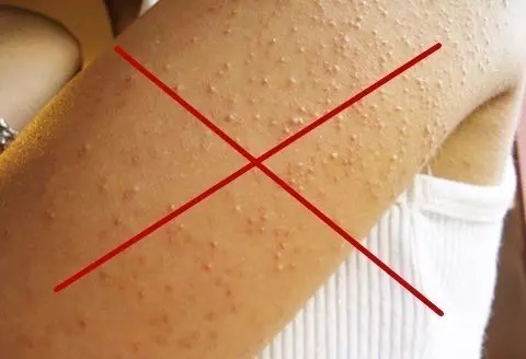 怎么消除鸡皮肤色素(怎么消除鸡皮肤色素沉淀) 怎么消除鸡皮肤色素(怎么消除鸡皮肤色素沉淀)