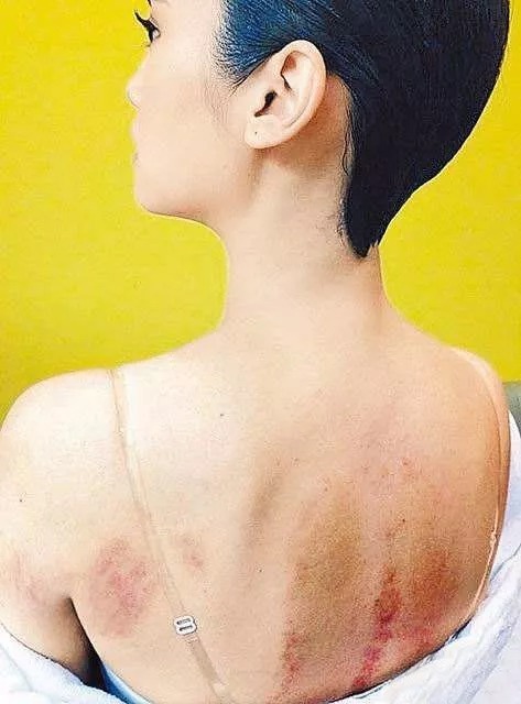 贾乃亮杨幂拔罐,刘涛佟大为刮痧,看大明星们都