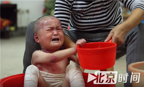 一摔一个疱 溃烂吞噬了手脚!蝴蝶宝贝:无法奔跑的童年 一摔一个疱 溃烂吞噬了手脚!蝴蝶宝贝:无法奔跑的童年