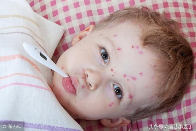 小孩出水痘的症状有哪些?小孩长水痘应注意什