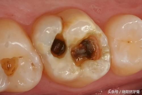 牙齿上有小黑点是怎么回事?