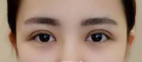 刚做完双眼皮前几天,眼睛肿的像熊猫眼