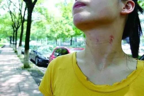 图为阿梅脖子被掐留下的伤痕
